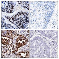 Adenocarcinoma diagnostiska markörer.jpg